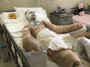 严重烧伤图片,严重烧伤病例深度解析